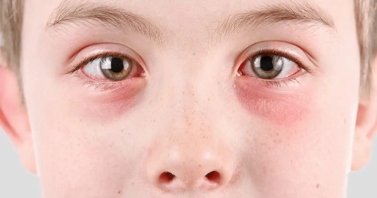 Conjunctivitis Does Not Have A Therapy