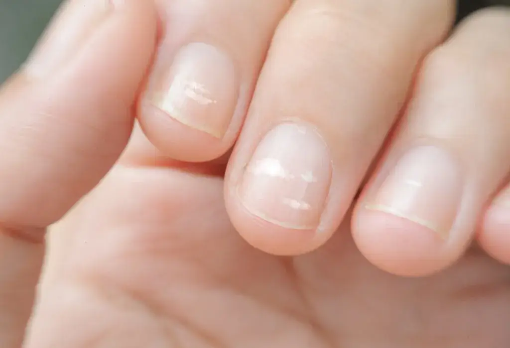 Pale Nails can sometimes be a sign of Congestive heart failure