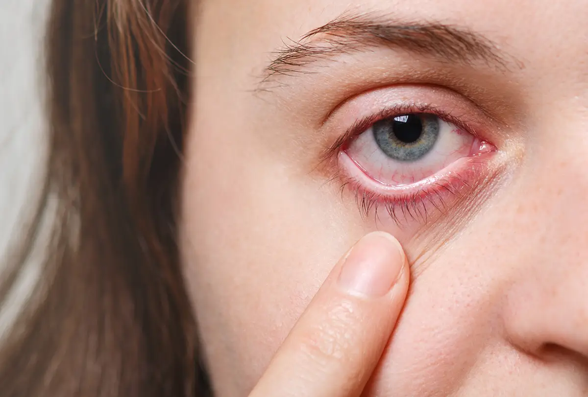 10 Common Pink Eye Myths