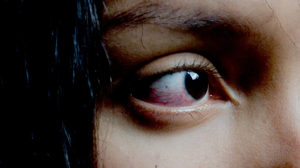 Pink Eye Can Cause Blindness Or Even Death