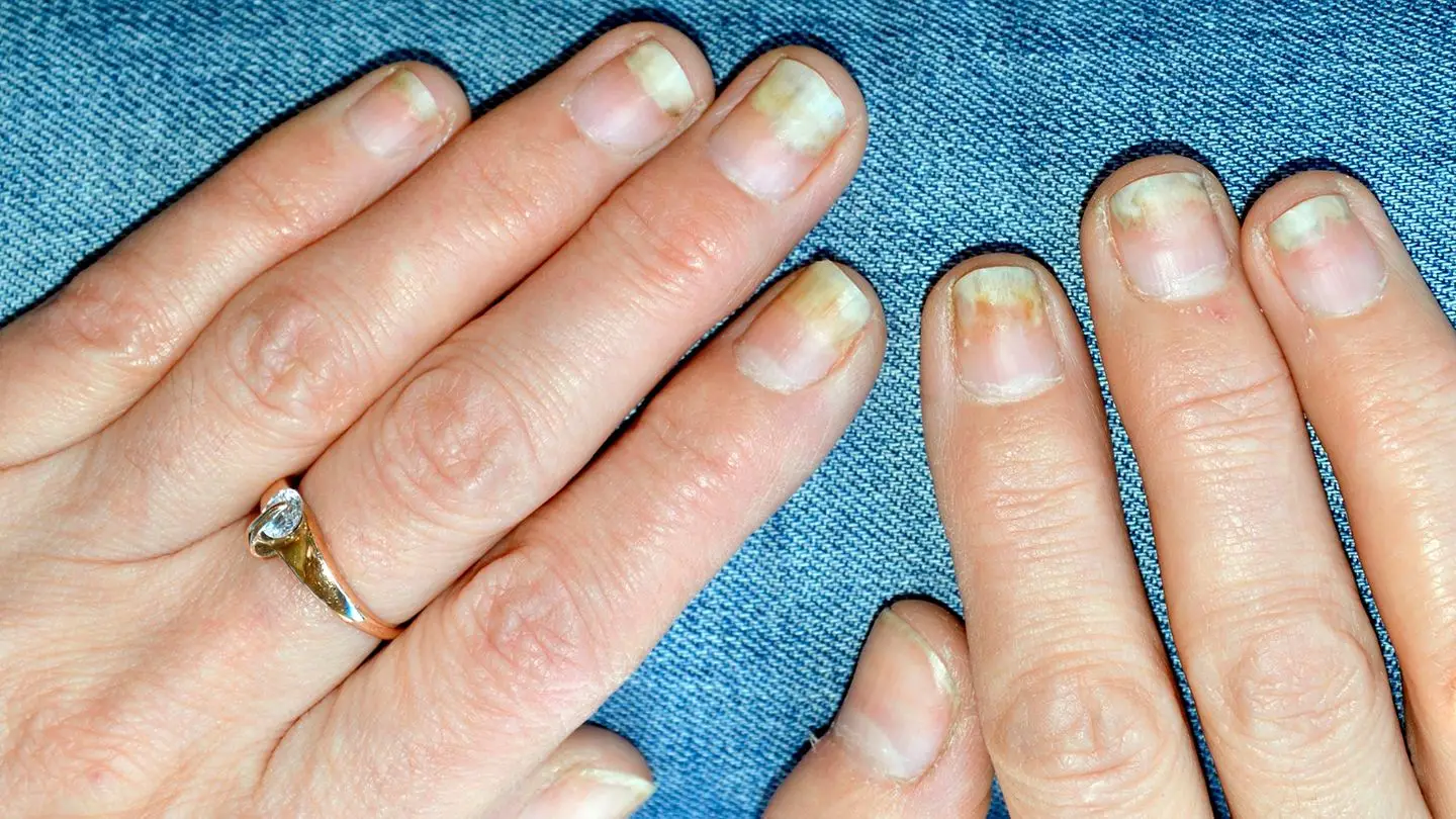 Rippled Nails are an early sign of psoriasis or inflammatory arthritis